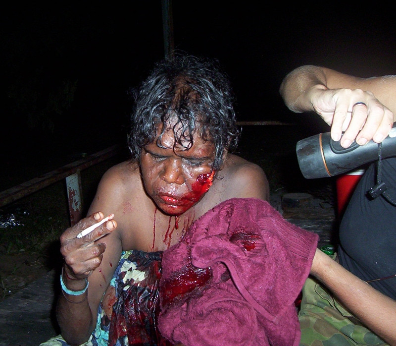 An aboriginal man relaxes with a joint after losing a drunken fight with a screen door.