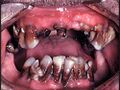 Methhead's teeth