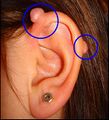 Bad piercings can sometimes lead to keloids